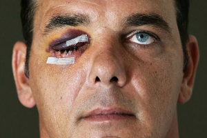 SURFISTA PODE PERDER VISÃO